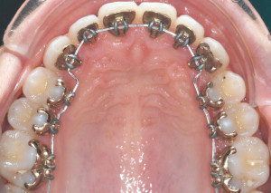 lingual-braces-023-300x213